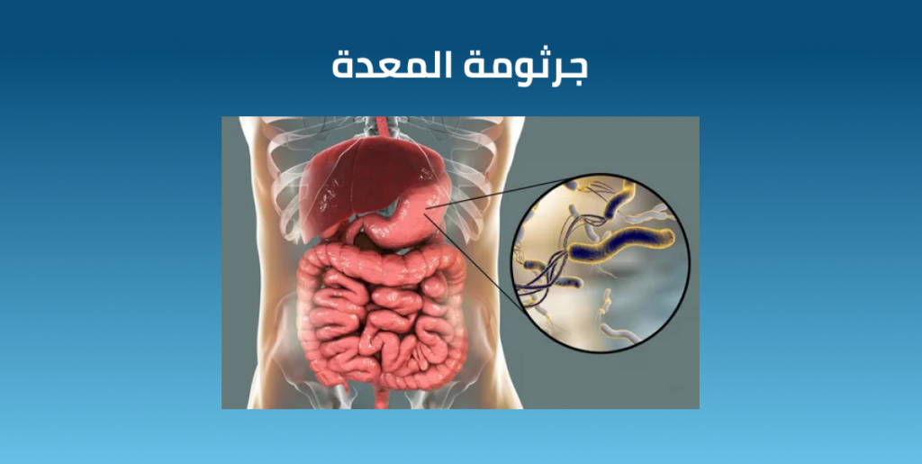 جرثومة المعدة