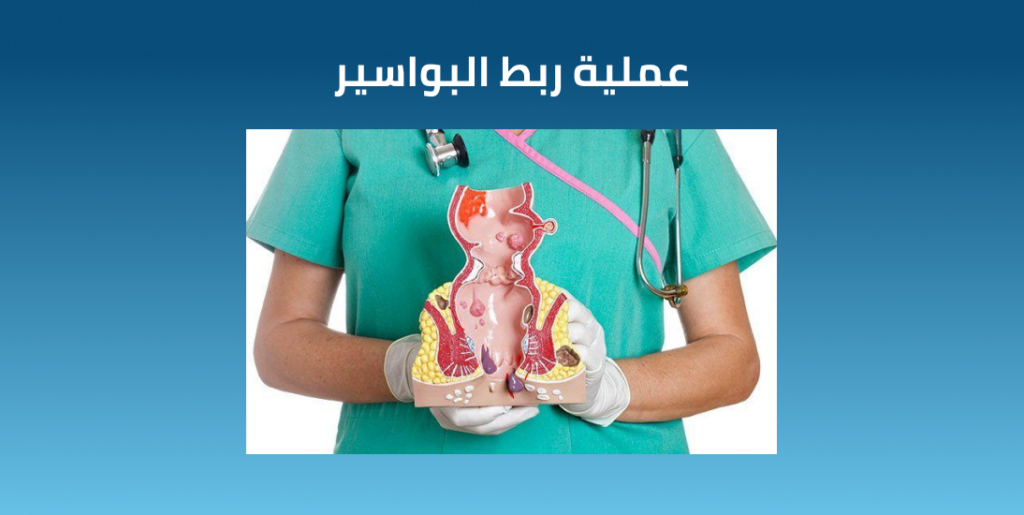 عملية ربط البواسير