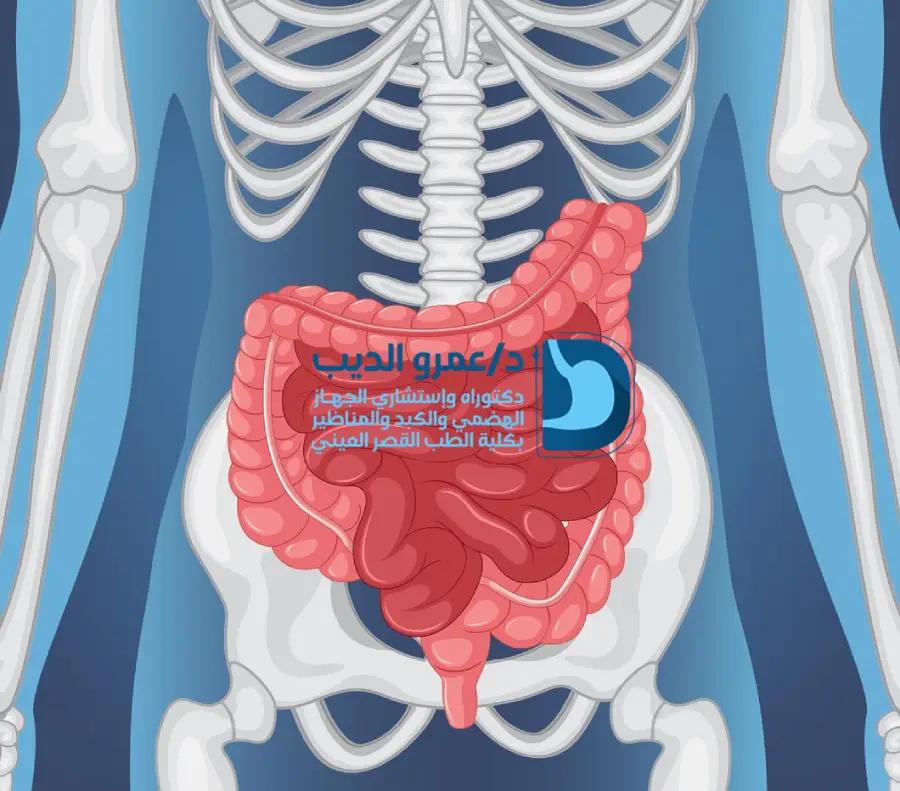 استئصال-القولون-بالمنظار