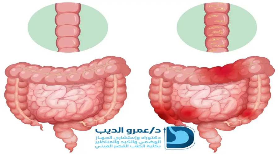استئصال-القولون-بالمنظار