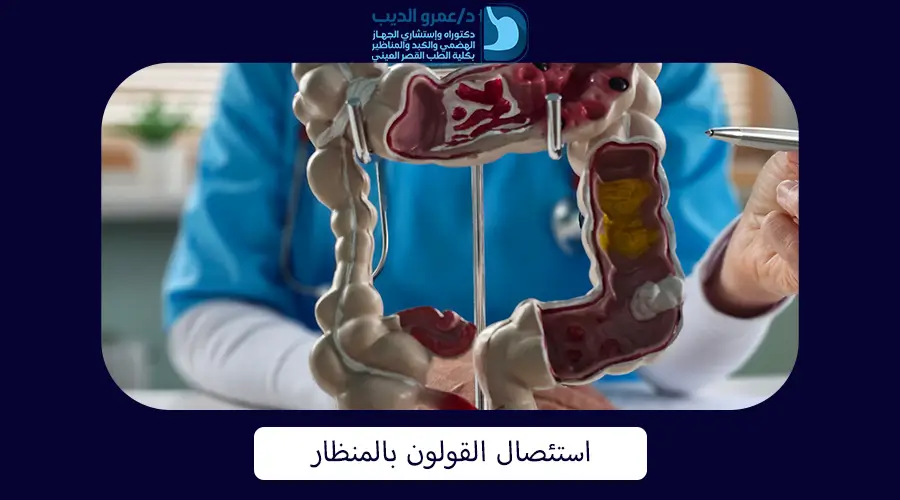 استئصال القولون بالمنظار