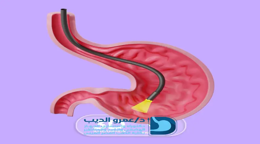 اعراض ارتجاع المريء الصامت
