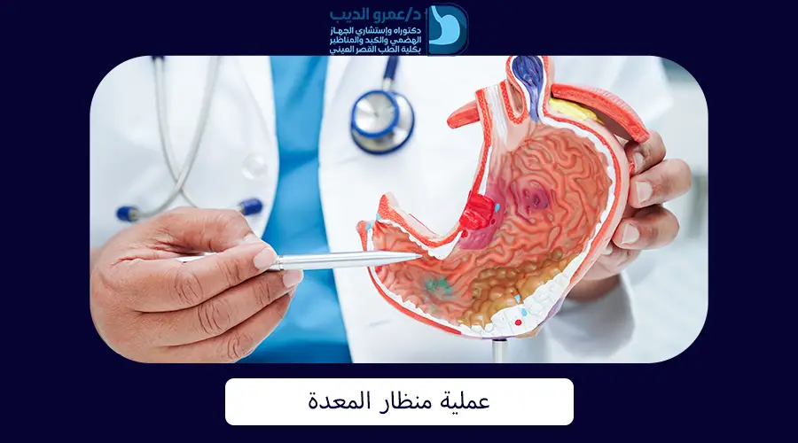 عملية-منظار-المعدة