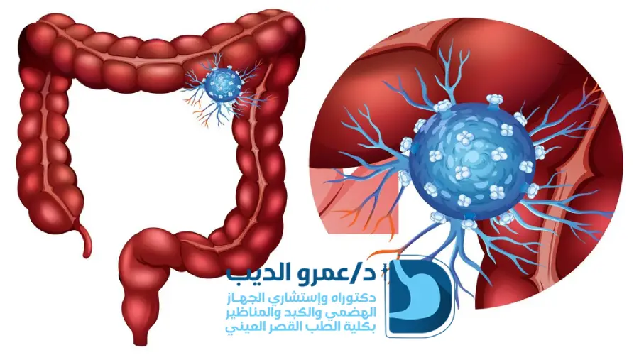 منظار القولون